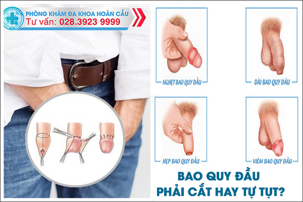 Dài - hẹp bao quy đầu cần phải cắt hay tự tuột