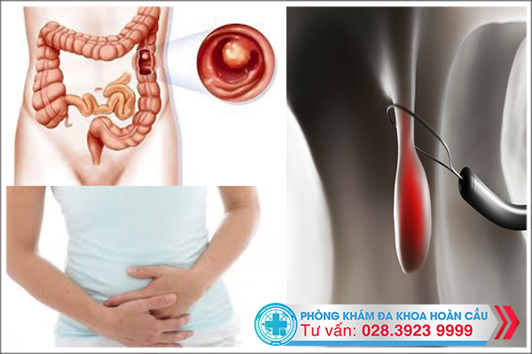 Cần sớm chữa bệnh polyp đại tràng