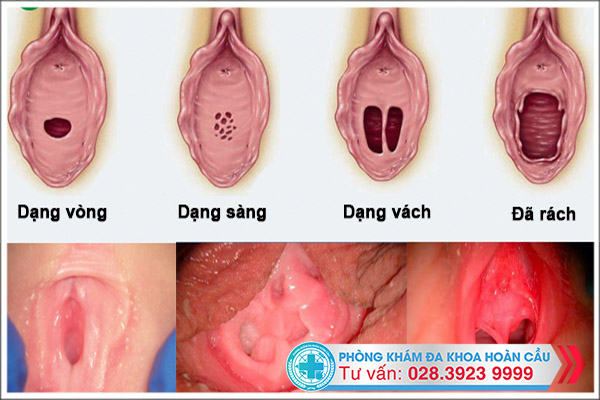 Có nhiều màng trinh bị rách ngay cả khi chưa quan hệ tình dục