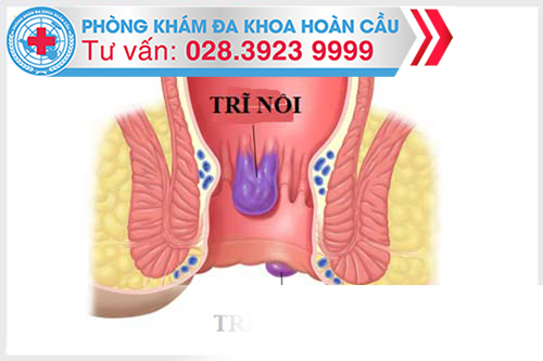 Nhận Biết Phân Loại Trĩ Nội Trĩ Ngoại Và Cấp Độ Của Bệnh Trĩ