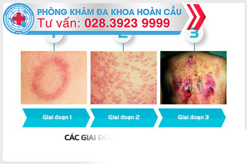 Các Giai Đoạn Đầu Của Bệnh Giang Mai Ở Nam Giới