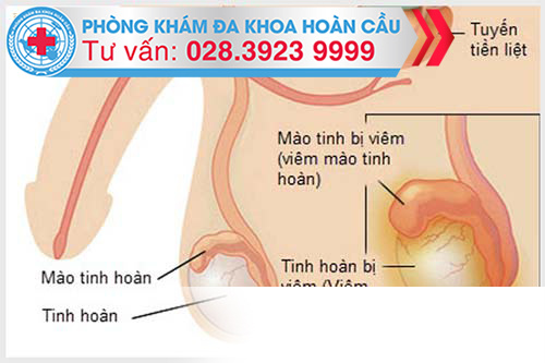 Những Dấu Hiệu Viêm Mào Tinh Hoàn Nào Giúp Bạn Dễ Nhận Thấy Nhất