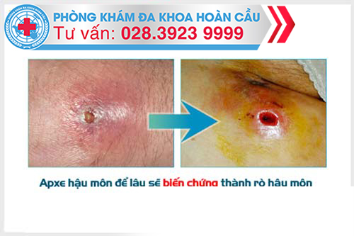 Apxe hậu môn để lâu sẽ biến chứng thành rò hậu môn