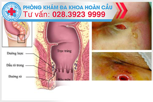 Chi phí điều trị rò hậu môn dứt điểm không tái phát là bao nhiêu?