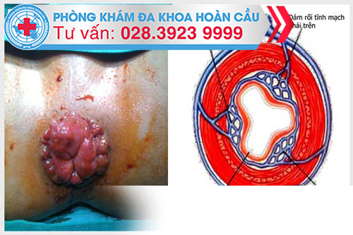 Hình ảnh bệnh trĩ vòng