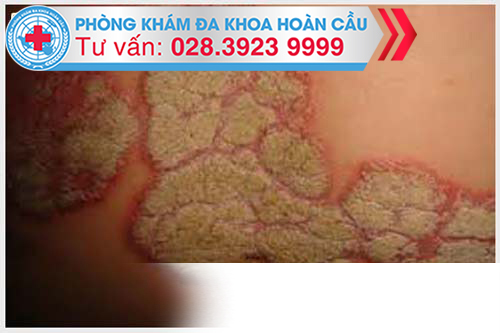 Bất cứ ai đang hoạt động tình dục cũng đều có thể bị nhiễm chlamydia