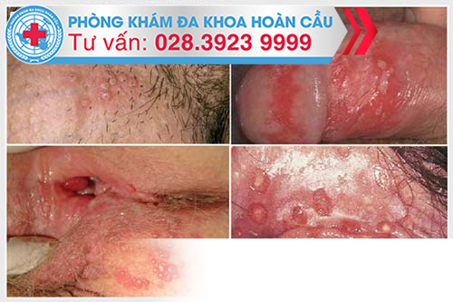 Hình ảnh mụn rộp sinh dục