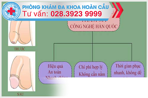 Đa Khoa Hoàn Cầu cắt bao quy đầu theo phương pháp hiện đại 