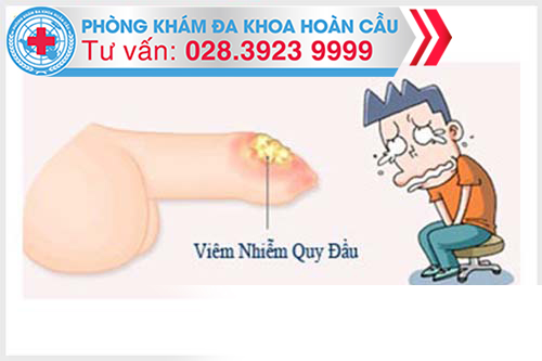 Viêm bao quy đầu nặng có thể gây lở loét vùng quy đầu