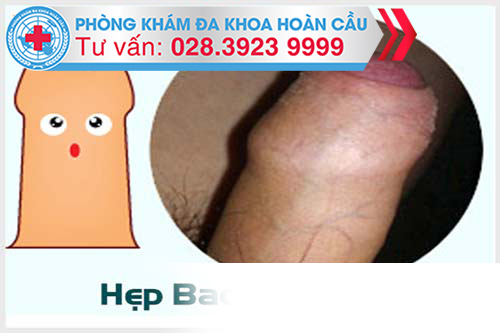 Dấu hiệu nhận biết bệnh hẹp bao quy đầu