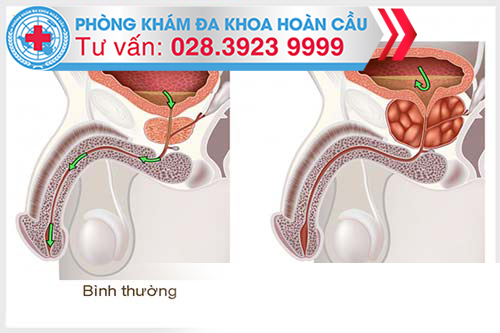 Bệnh lý tuyến tiền liệt