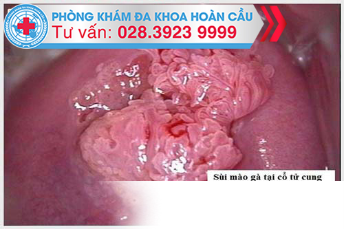 Hình ảnh sùi mà gà ở cổ tử cung  