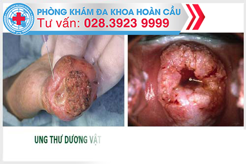 Biến chứng sùi mào gà nguy hiểm nhất là ung thư dương vật, cổ tử cung